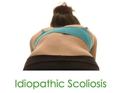 Scoliosis Information Evening Date: September 24 Time: 6:30 PM – 8:00