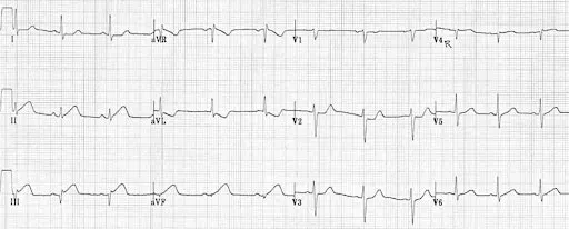 ECG workshop for STEMI, STEMI equivalents and STEMI mimic patterns.