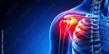 The Journey of an Upper Limb Injury:  A Multidisciplinary Approach to Recovery Across TAC & Workcover