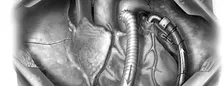 Advanced Heart Failure Symposium - MCS