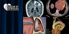 14ème Symposium Coeur et Cerveau