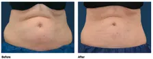 You’re Invited: The CoolSculpting Event at Neem Medical Spa Salem