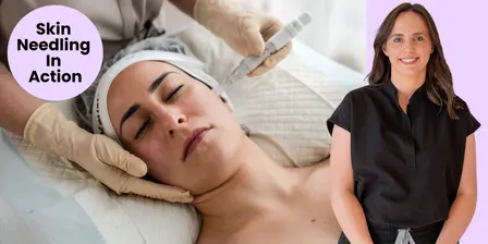 Skin Needling In Action
