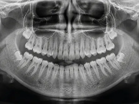 How To Read a Dental X-Ray
