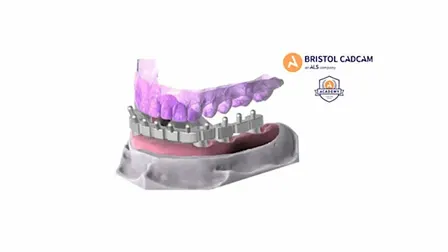 Exocad Advanced- Full Arch Bar Design