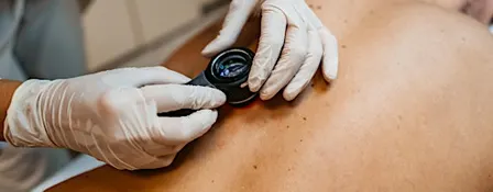 Melanoma Study Day