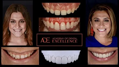 Precision Crown Lengthening for the Modern General Dentist (Perth)