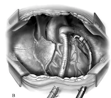 Advanced Heart Failure Symposium - MCS