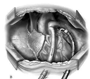 Advanced Heart Failure Symposium - MCS