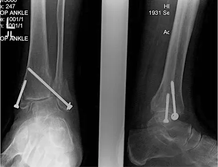 CURRENT CONTROVERSIES IN ANKLE FRACTURE MANAGEMENT