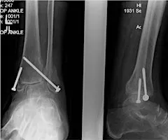 CURRENT CONTROVERSIES IN ANKLE FRACTURE MANAGEMENT