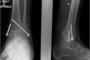 CURRENT CONTROVERSIES IN ANKLE FRACTURE MANAGEMENT