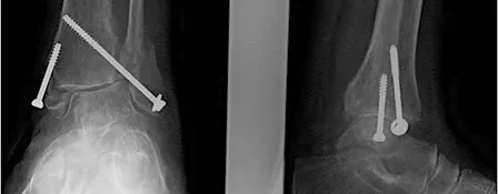 CURRENT CONTROVERSIES IN ANKLE FRACTURE MANAGEMENT