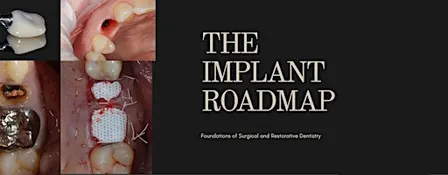 The Implant Roadmap 101