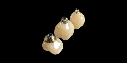 1. Single Screw-Retained Crown - Contour, Stain, Glaze, Cementation & QC