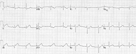 ECG workshop for STEMI, STEMI equivalents and STEMI mimic patterns.