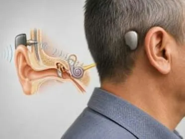 Full event BONE CONDUCTION HEARING IMPLANT Course