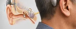 BONE CONDUCTION HEARING IMPLANT Course