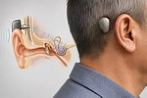 Full event BONE CONDUCTION HEARING IMPLANT Course