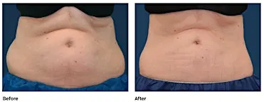 You’re Invited: The CoolSculpting Event at Neem Medical Spa Salem